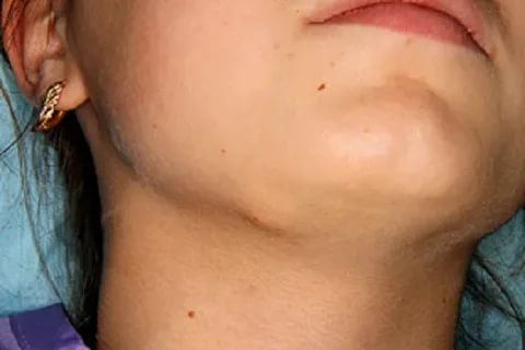 Кольцевидная гранулёма: лечение, фото, причины и симптомы